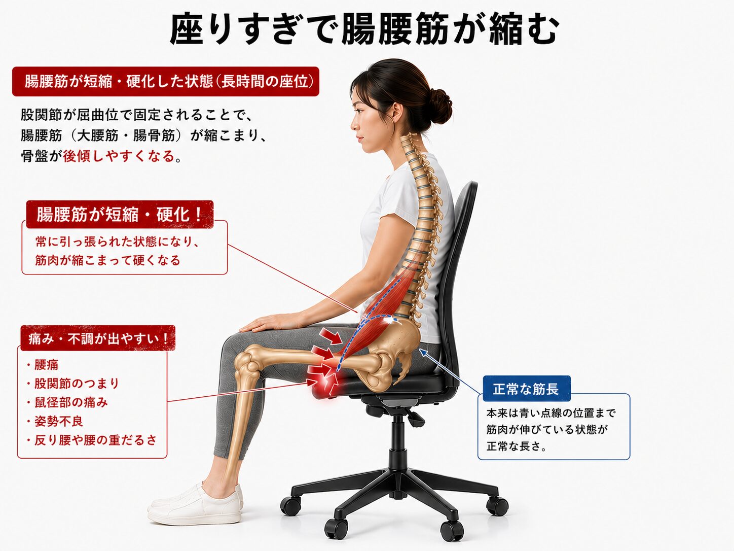 腸腰筋短縮のイメージ